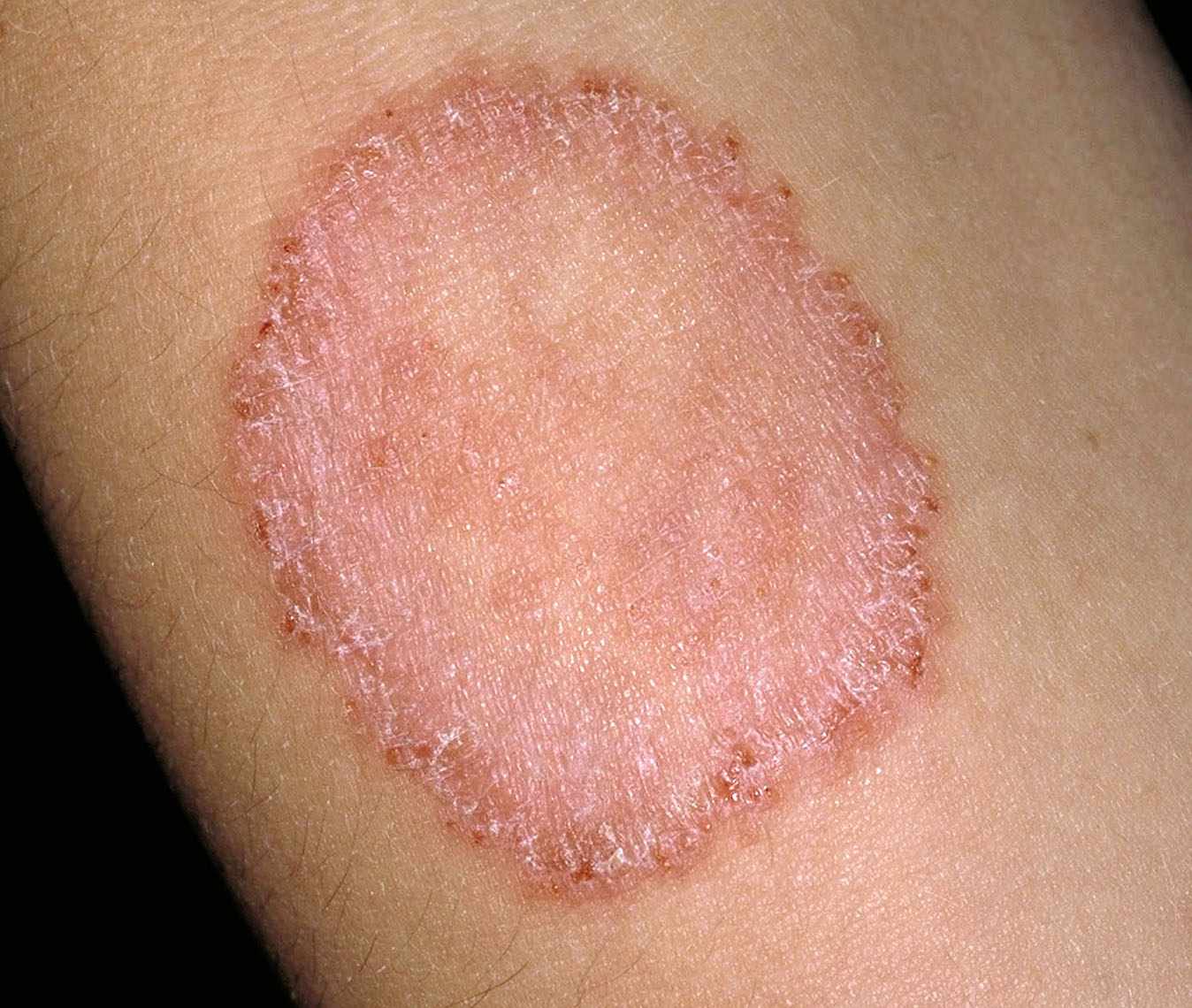 Ringworm (Tinea Corporis) Condition, Treatments and Pictures for Children -  Skinsight
